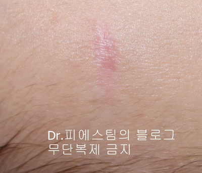 응급실에서 얼굴 상처 일반 봉합 후, 성형외과 흉터 레이저 치료 사례 - 뺨 & 이마 (2) 입니다 관련 이미지 4