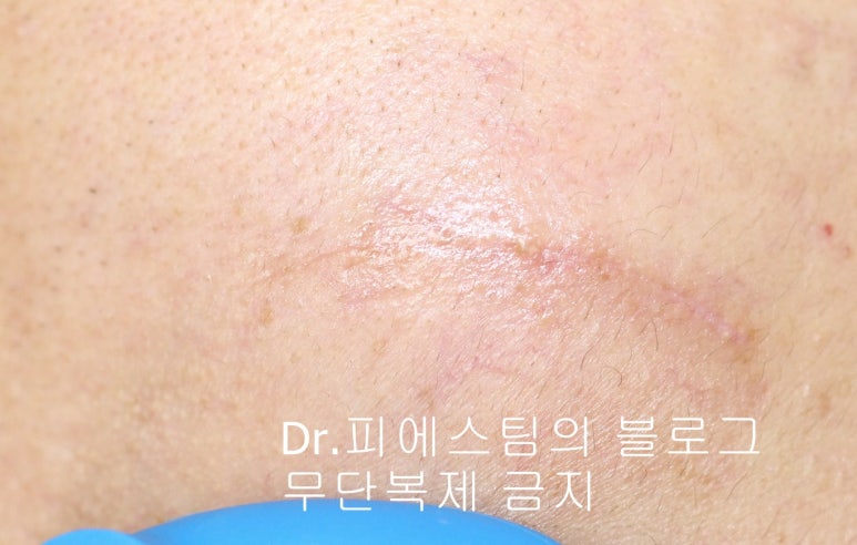 얼굴 찢어진 상처 봉합 성형외과 치료 사례 - 들린 상처: 피판에 관하여 2편입니다 입니다 관련 이미지 6