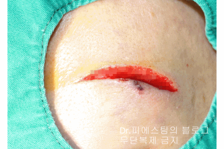 얼굴 찢어진 상처 봉합 성형외과 치료 사례 - 들린 상처: 피판에 관하여 2편입니다 입니다 관련 이미지 13