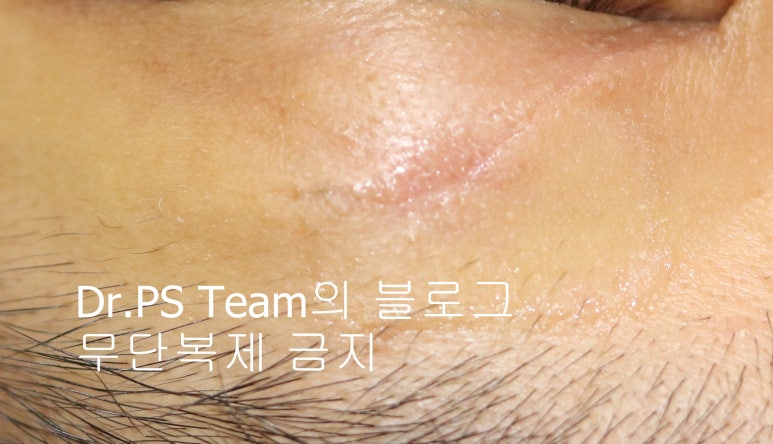 얼굴 찢어진 상처 미세 봉합 & 흉터 레이저 성형외과 치료 사례 - 상안검 편입니다. 관련 이미지 2