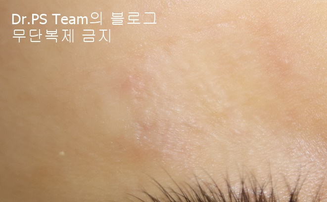 얼굴 찢어진 상처 봉합 & 얼굴 흉터 레이저 성형외과 치료 사례 - 늦어진 상처 봉합 (Delayed wound closure) II - 하안검 편입니다. 관련 이미지 7