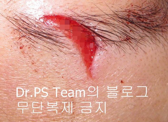 얼굴 찢어진 상처 봉합 성형외과 치료 사례 - 눈썹과 이마 편입니다. 관련 이미지 2
