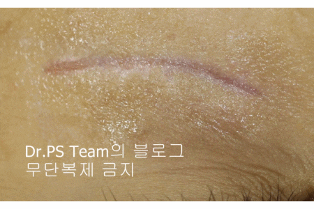 응급실에서 얼굴 상처 일반 봉합 후, 성형외과 흉터 레이저 치료 사례 - 하안검(아래눈꺼풀) 편 입니다 관련 이미지 10