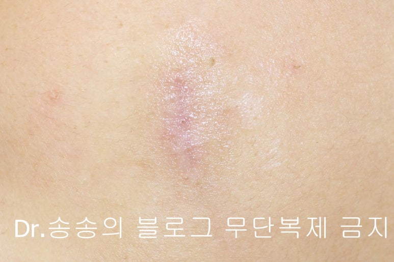 얼굴 상처 봉합 성형외과 치료 사례 - 뺨 1편 관련 이미지 6