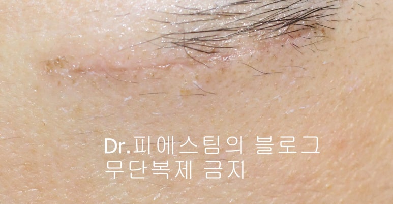 얼굴 찢어진 상처 봉합 성형외과 치료 사례 - 응급실 봉합 vs 성형외과 전문의 미세봉합 편입니다 관련 이미지 7