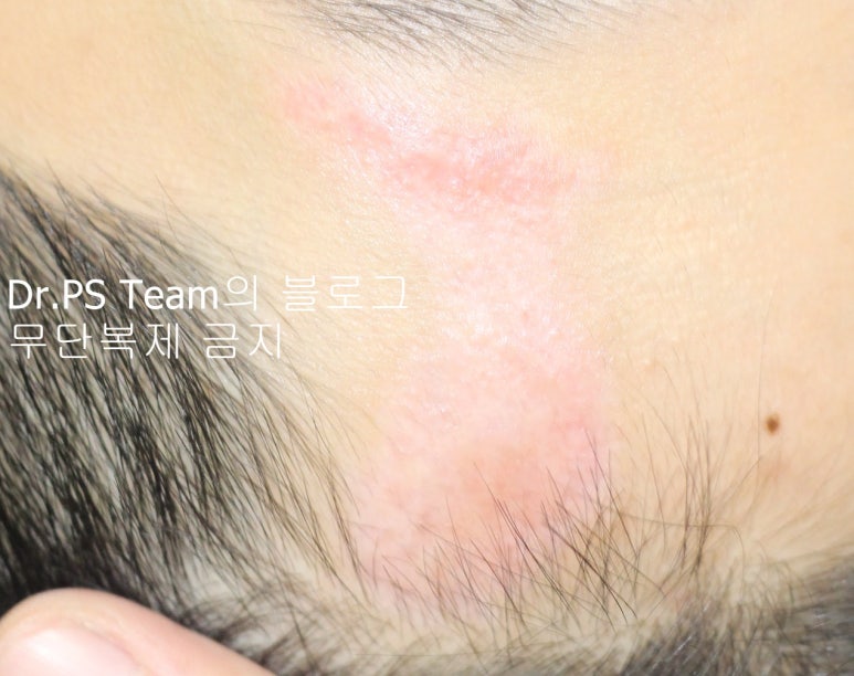 얼굴 찢어진 상처 봉합 & 얼굴 흉터 레이저 성형외과 치료 사례 - 큰 피부 결손 편입니다. 관련 이미지 6