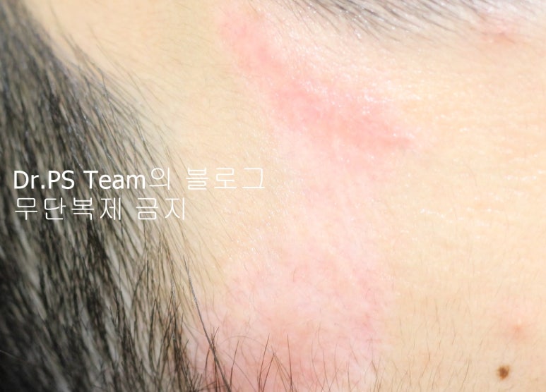 얼굴 찢어진 상처 봉합 & 얼굴 흉터 레이저 성형외과 치료 사례 - 큰 피부 결손 편입니다. 관련 이미지 7