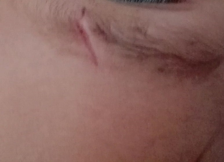 얼굴 찢어진 상처 봉합 성형외과 치료 사례 - 눈썹과 이마 편입니다. 관련 이미지 8