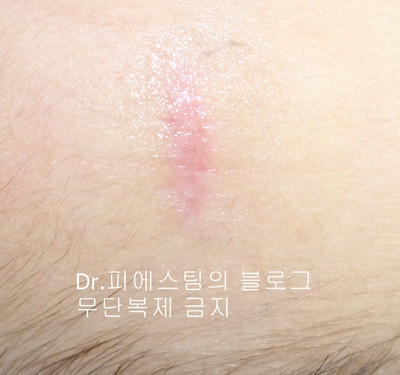 응급실에서 얼굴 상처 일반 봉합 후, 성형외과 흉터 레이저 치료 사례 - 뺨 & 이마 (2) 입니다 관련 이미지 3