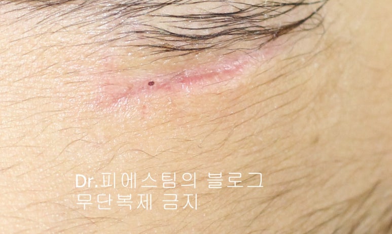 얼굴 찢어진 상처 봉합 성형외과 치료 사례 - 응급실 봉합 vs 성형외과 전문의 미세봉합 편입니다 관련 이미지 2