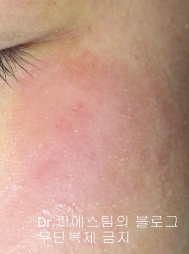 얼굴 상처 봉합 외 표재성 손상, 찰과상의 성형외과 색소침착 치료 사례 - 광대 편입니다 관련 이미지 3