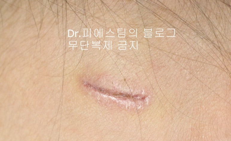 응급실에서 얼굴 상처 일반 봉합 후, 성형외과 흉터 레이저 치료 사례 - 뺨 & 이마 (2) 입니다 관련 이미지 6