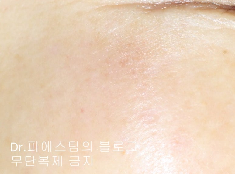 얼굴 상처 봉합 외 표재성 손상, 찰과상의 성형외과 색소침착 치료 사례 - 광대 편입니다 관련 이미지 14