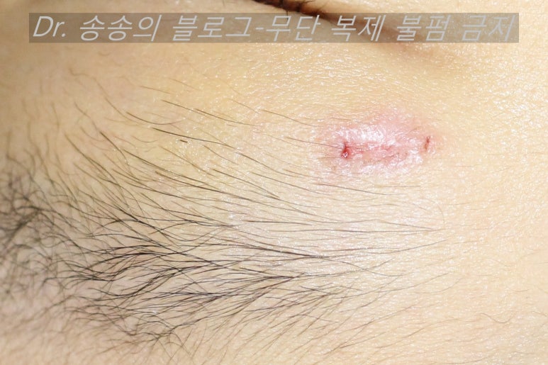 얼굴 상처 봉합 성형외과 치료 사례 - 눈꺼풀 1편 관련 이미지 11