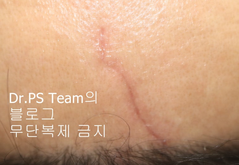 얼굴 찢어진 상처 봉합 & 얼굴 흉터 레이저 성형외과 치료 사례 - 이마 상처 (2) 편입니다. 관련 이미지 4