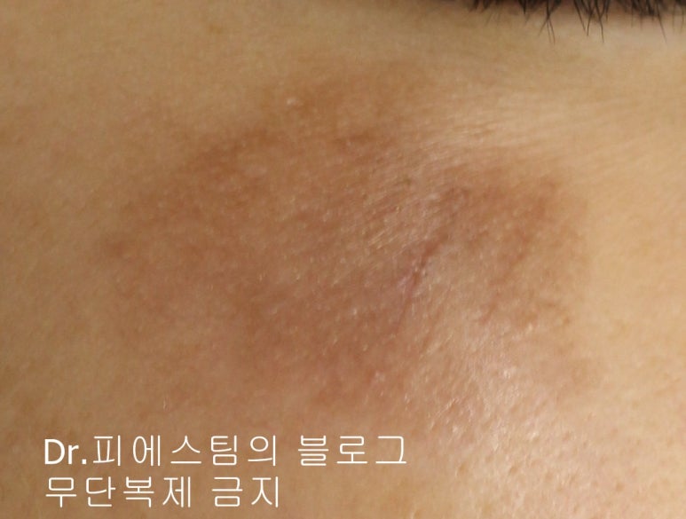 얼굴 상처 봉합 외 표재성 손상, 찰과상의 성형외과 색소침착 치료 사례 - 광대 편입니다 관련 이미지 9