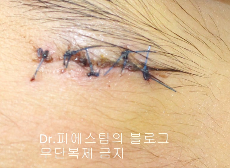 얼굴 찢어진 상처 봉합 성형외과 치료 사례 - 응급실 봉합 vs 성형외과 전문의 미세봉합 편입니다 관련 이미지 1