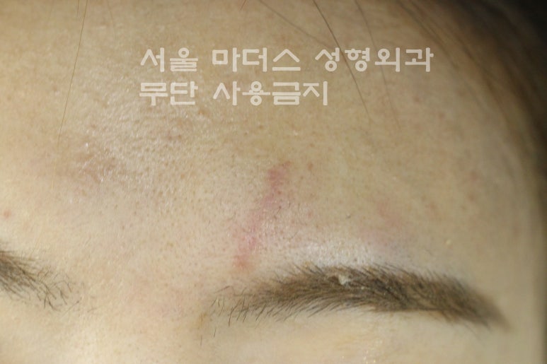 얼굴 상처 봉합 성형외과 - 이마 상처 : 미세 봉합 & 흉터 레이저 관련 이미지 6