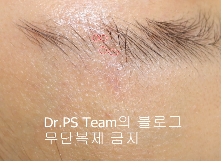 얼굴 찢어진 상처 봉합 성형외과 치료 사례 - 눈썹과 이마 편입니다. 관련 이미지 7