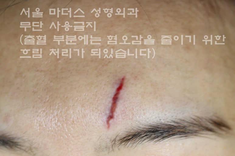 얼굴 상처 봉합 성형외과 - 이마 상처 : 미세 봉합 & 흉터 레이저 관련 이미지 2