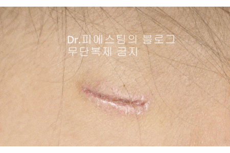 응급실에서 얼굴 상처 일반 봉합 후, 성형외과 흉터 레이저 치료 사례 - 뺨 & 이마 (2) 입니다 관련 이미지 14