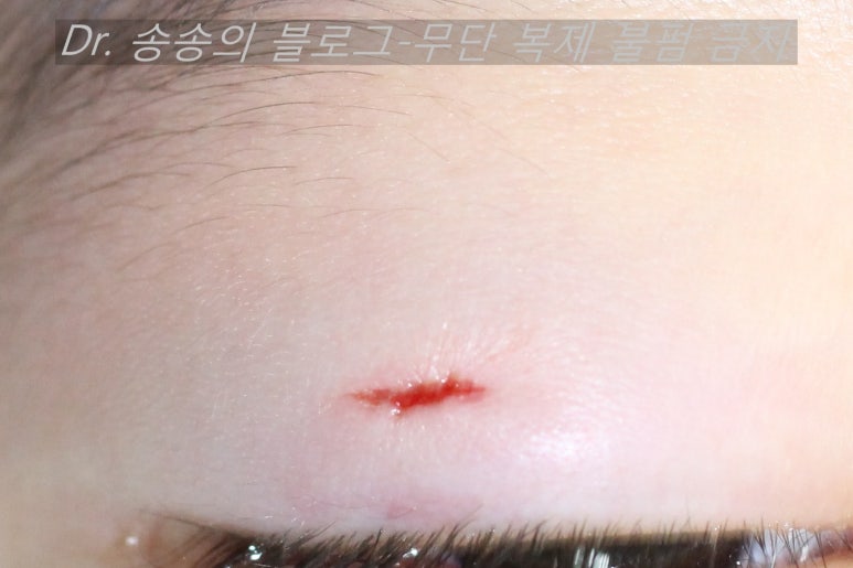 얼굴 상처 봉합 성형외과 치료 사례 - 눈꺼풀 1편 관련 이미지 2