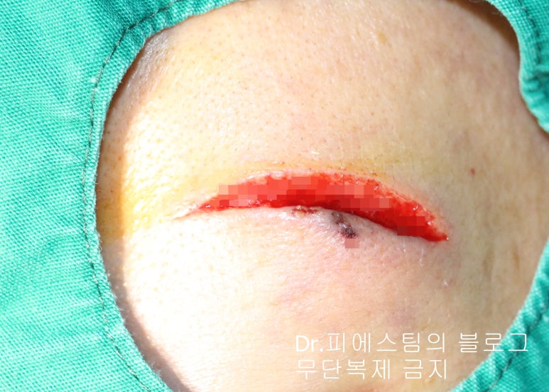 얼굴 찢어진 상처 봉합 성형외과 치료 사례 - 들린 상처: 피판에 관하여 2편입니다 입니다 관련 이미지 1