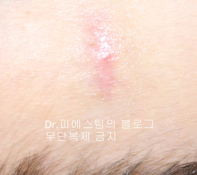응급실에서 얼굴 상처 일반 봉합 후, 성형외과 흉터 레이저 치료 사례 - 뺨 & 이마 (2) 입니다 관련 이미지 2