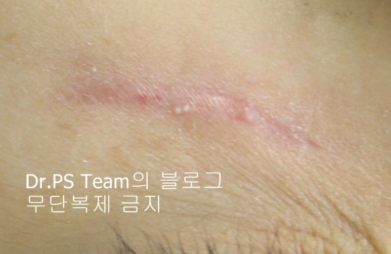 응급실에서 얼굴 상처 일반 봉합 후, 성형외과 흉터 레이저 치료 사례 - 하안검(아래눈꺼풀) 편 입니다 관련 이미지 5