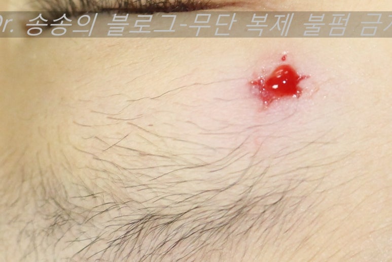 얼굴 상처 봉합 성형외과 치료 사례 - 눈꺼풀 1편 관련 이미지 9