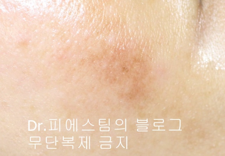 얼굴 상처 봉합 외 표재성 손상, 찰과상의 성형외과 색소침착 치료 사례 - 광대 편입니다 관련 이미지 6