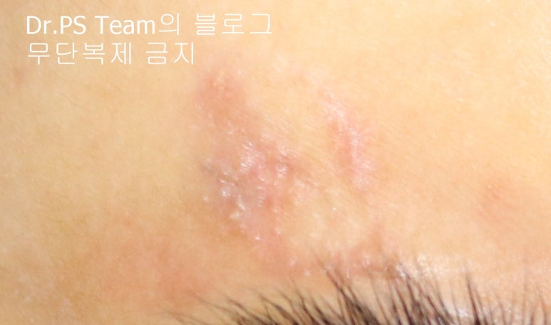 얼굴 찢어진 상처 봉합 & 얼굴 흉터 레이저 성형외과 치료 사례 - 늦어진 상처 봉합 (Delayed wound closure) II - 하안검 편입니다. 관련 이미지 4