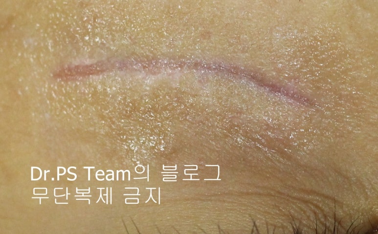 응급실에서 얼굴 상처 일반 봉합 후, 성형외과 흉터 레이저 치료 사례 - 하안검(아래눈꺼풀) 편 입니다 관련 이미지 1