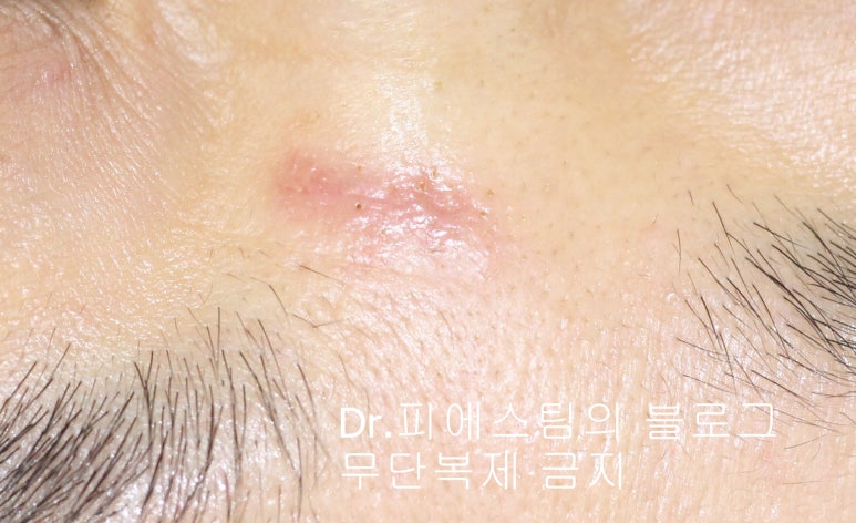 얼굴 찢어진 상처 봉합 성형외과 치료 사례 - 코와 피판에 관하여-1편입니다 관련 이미지 6