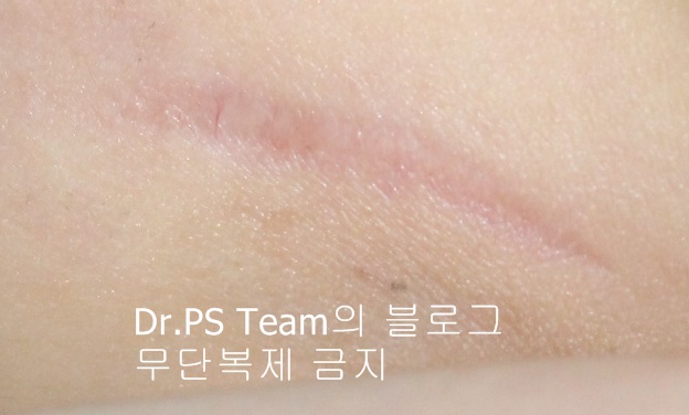 응급실에서 얼굴 상처 일반 봉합 후, 성형외과 흉터 레이저 치료 사례 - 하안검(아래눈꺼풀) 편 입니다 관련 이미지 6