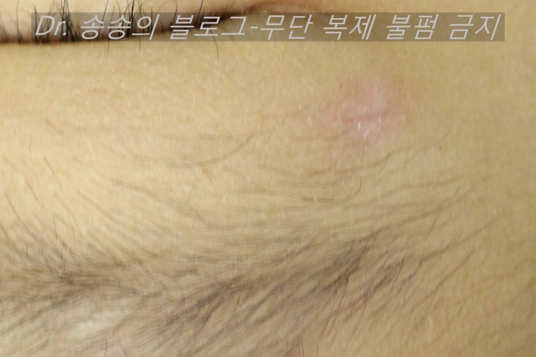 얼굴 상처 봉합 성형외과 치료 사례 - 눈꺼풀 1편 관련 이미지 12