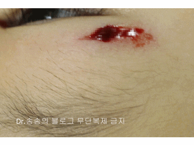 얼굴 상처 봉합 성형외과 치료 사례 - 눈꺼풀 2편 관련 이미지 9