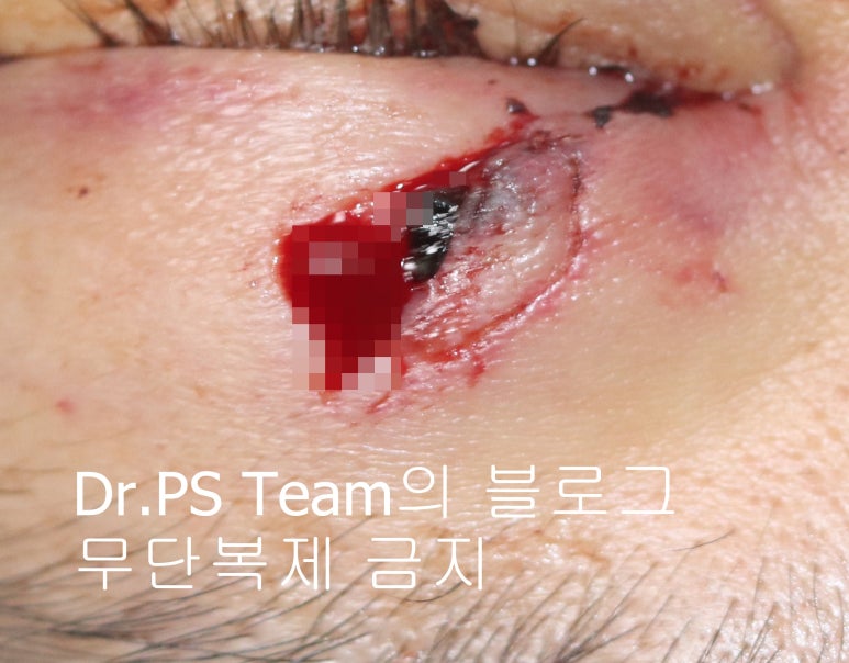 얼굴 찢어진 상처 미세 봉합 & 흉터 레이저 성형외과 치료 사례 - 상안검 편입니다. 관련 이미지 1