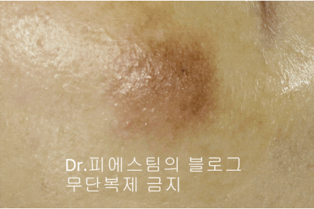 얼굴 상처 봉합 외 표재성 손상, 찰과상의 성형외과 색소침착 치료 사례 - 광대 편입니다 관련 이미지 16