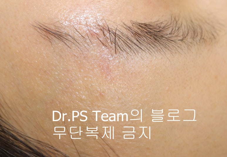 얼굴 찢어진 상처 봉합 성형외과 치료 사례 - 눈썹과 이마 편입니다. 관련 이미지 6