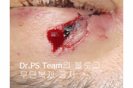 얼굴 찢어진 상처 미세 봉합 & 흉터 레이저 성형외과 치료 사례 - 상안검 편입니다. 관련 이미지 12