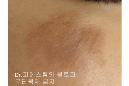 얼굴 상처 봉합 외 표재성 손상, 찰과상의 성형외과 색소침착 치료 사례 - 광대 편입니다 관련 이미지 17
