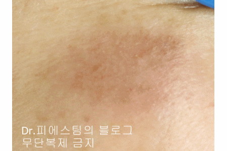 얼굴 상처 봉합 외 표재성 손상, 찰과상의 성형외과 색소침착 치료 사례 - 광대 편입니다 관련 이미지 18