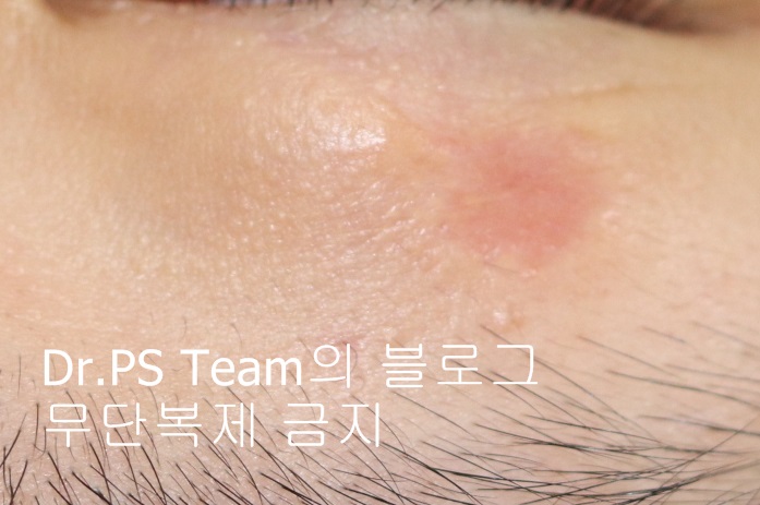 얼굴 찢어진 상처 미세 봉합 & 흉터 레이저 성형외과 치료 사례 - 상안검 편입니다. 관련 이미지 11