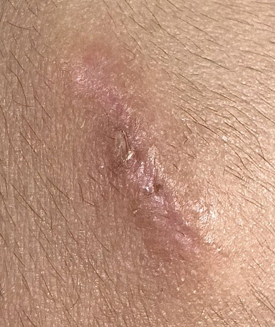 Milia and Dissolved Thread Exposure image 6