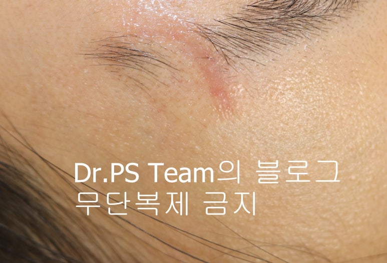 얼굴 찢어진 상처 봉합 성형외과 치료 사례 - 눈썹과 이마 편입니다. 관련 이미지 4