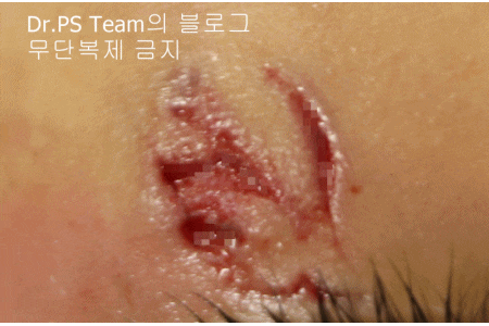 얼굴 찢어진 상처 봉합 & 얼굴 흉터 레이저 성형외과 치료 사례 - 늦어진 상처 봉합 (Delayed wound closure) II - 하안검 편입니다. 관련 이미지 9