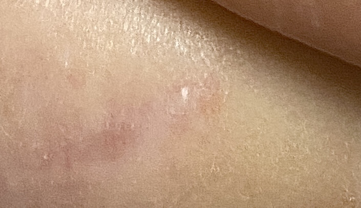 Milia and Dissolved Thread Exposure image 7