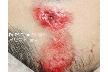 얼굴 찢어진 상처 봉합 & 얼굴 흉터 레이저 성형외과 치료 사례 - 큰 피부 결손 편입니다. 관련 이미지 10