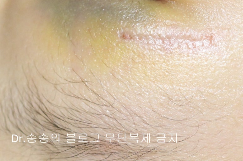 얼굴 상처 봉합 성형외과 치료 사례 - 눈꺼풀 2편 관련 이미지 2